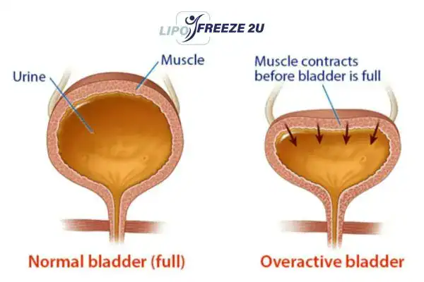 diagram of overactive bladder treatment Huddersfield