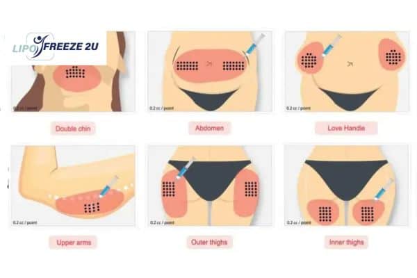 Benefits of Choosing Aqualyx for Fat Reduction Huddersfield
