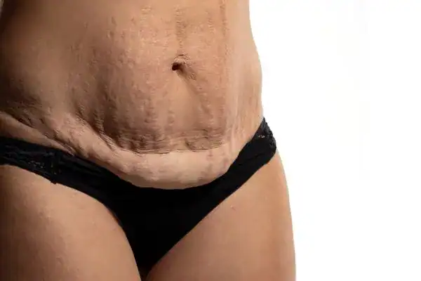 loose skin after weight loss injections Huddersfield