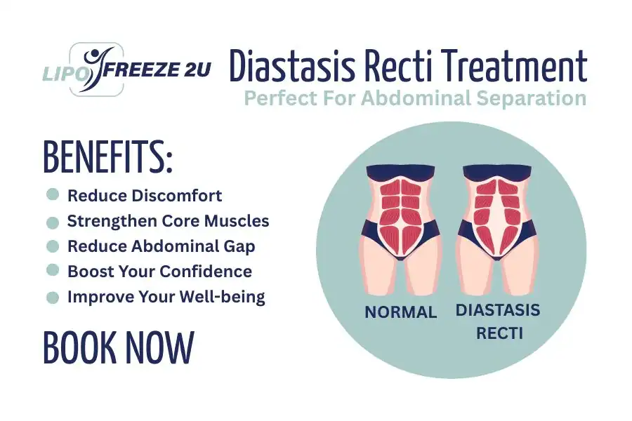 How Long Will It Take to See Improvements in Diastasis Recti Huddersfield