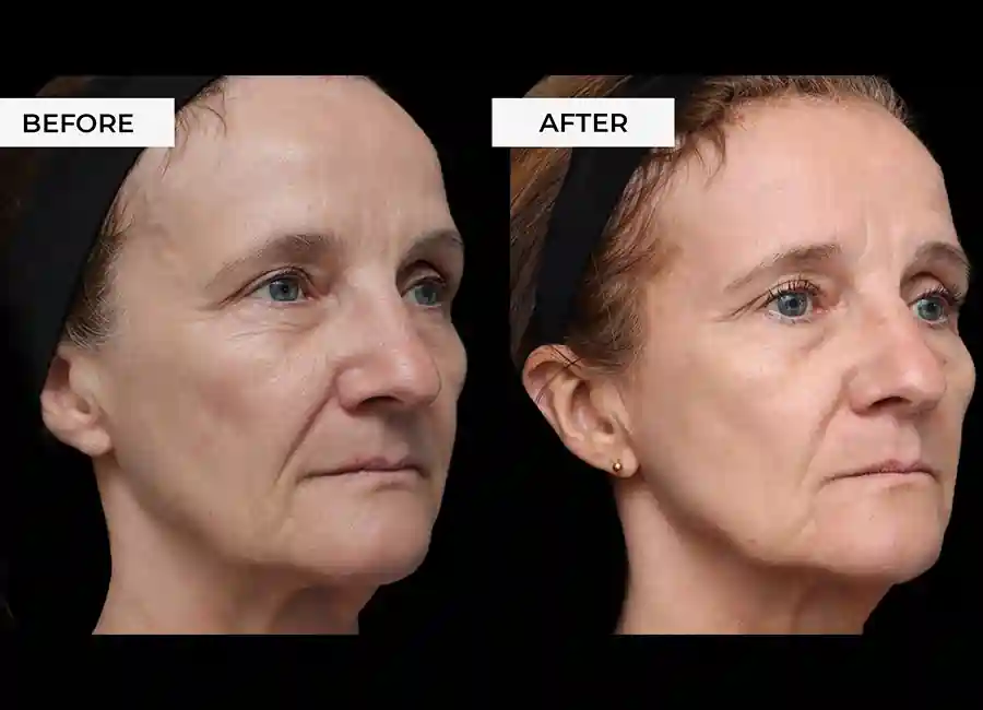 How Many RF Microneedling Sessions Will You Need to See a Difference Huddersfield?