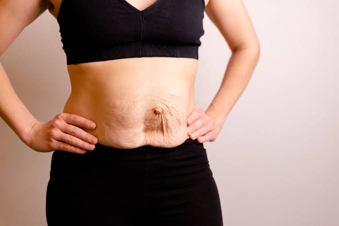 Is Surgery Really the Only Way to Repair Diastasis Recti Huddersfield?